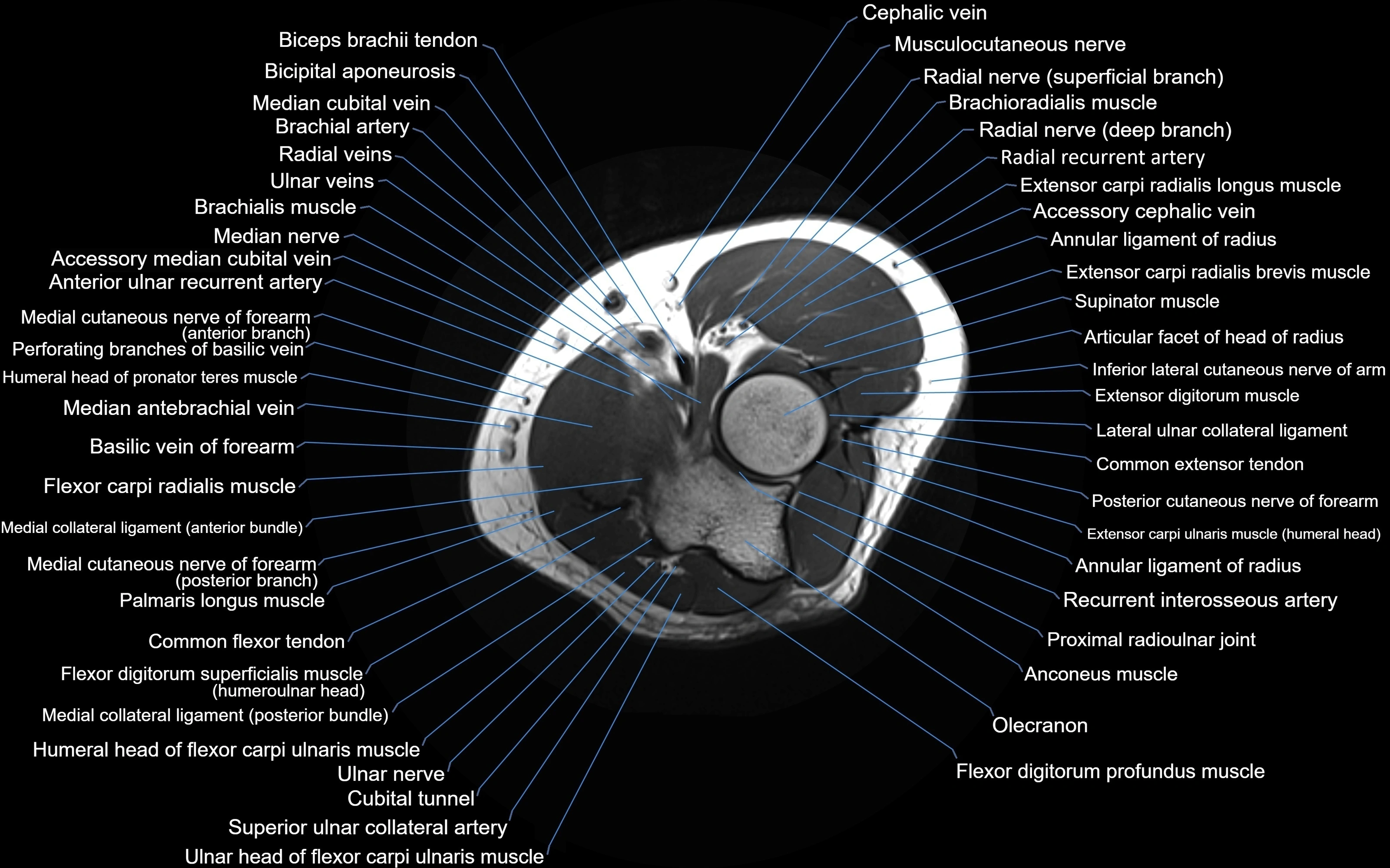 MRI elbow axial cross sectional anatomy 3T  radiology  image-img-00001-00018.webp